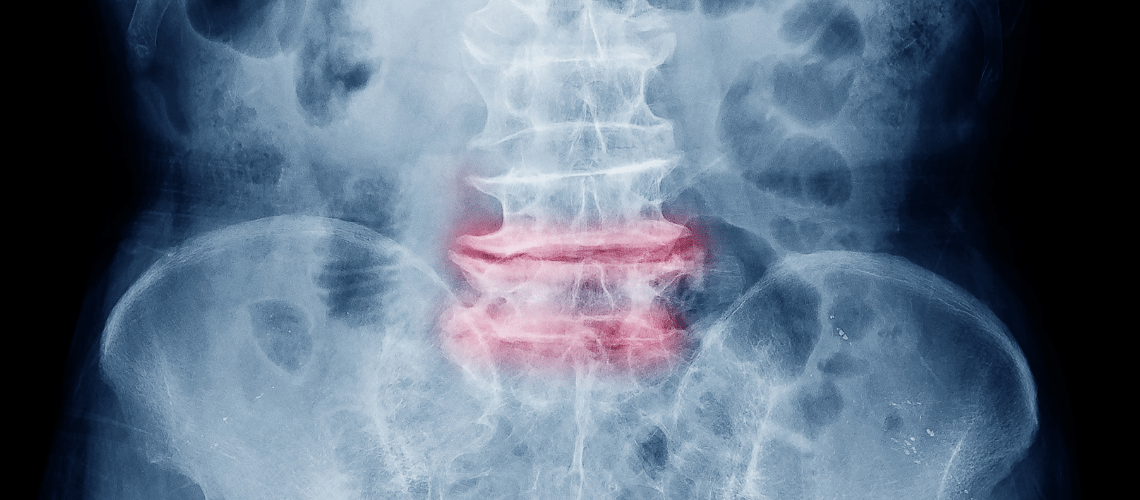 spinal stenosis